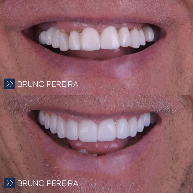 carillas-dentales-marbella-41