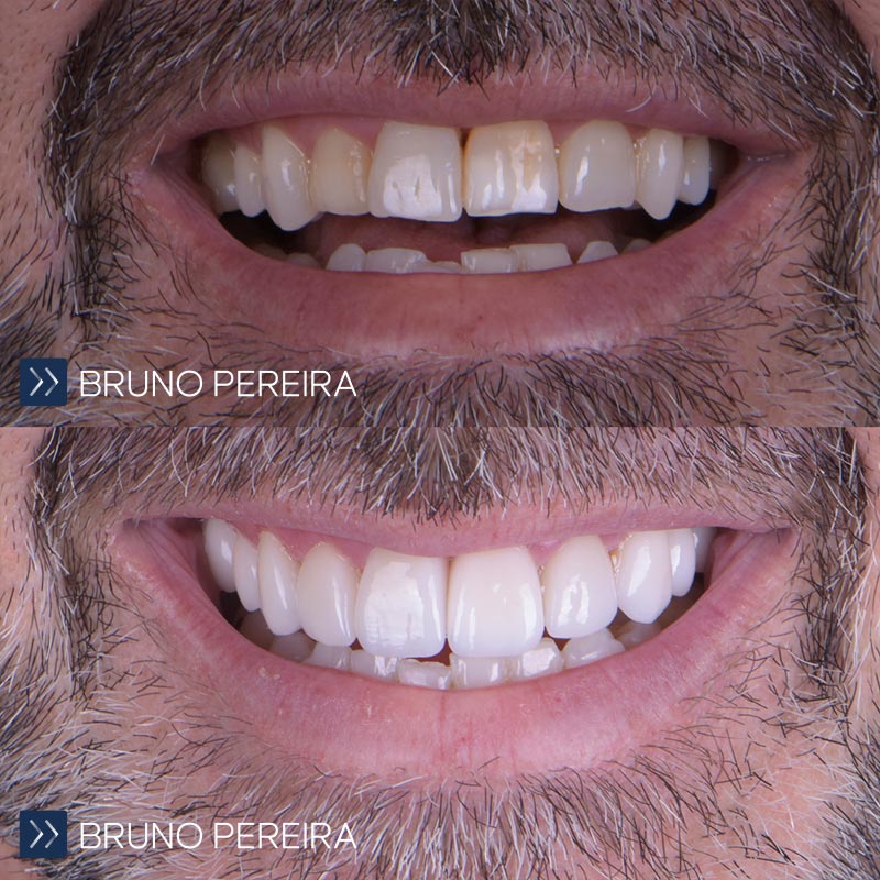 carillas-dentales-marbella-74