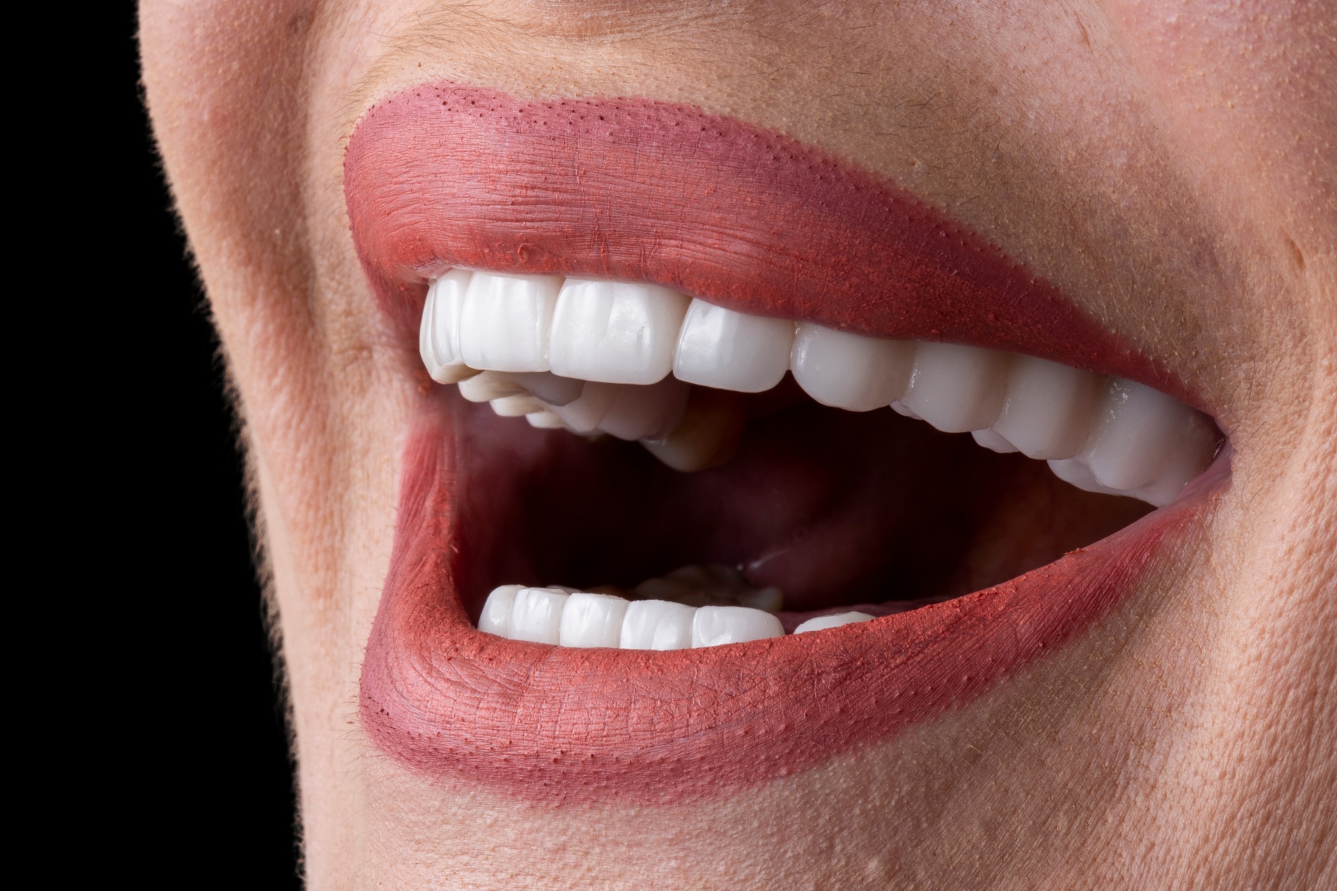 Carillas dentales en Turquía